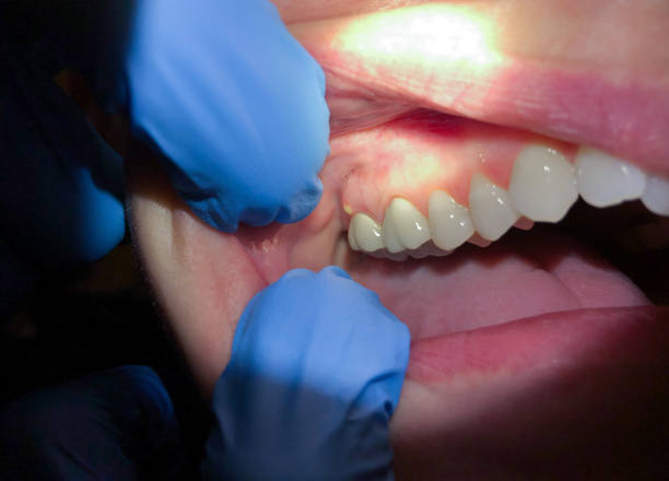 Best Lost Filling or Crown Replacement in Berryville, TX
